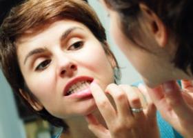 Bolezen dlesni pri odraslih - zdravljenje z ljudskimi zdravili