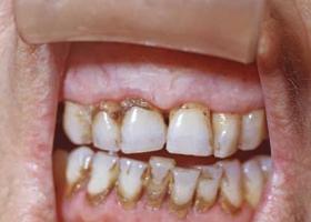 Zobni karies - vzroki, simptomi, zdravljenje in preprečevanje kariesa